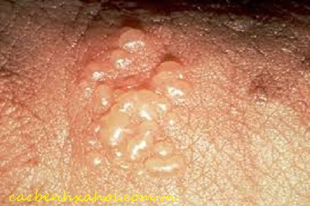 Herpes sinh dục là bệnh gì?
