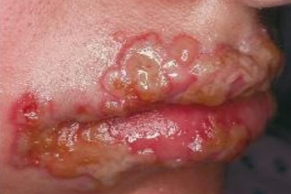 Hình ảnh người mắc bệnh herpes sinh dục ở môi