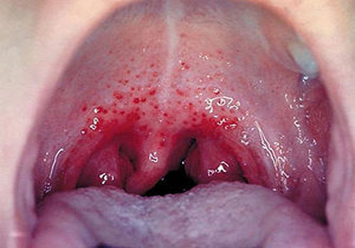 Hình ảnh bệnh lậu miệng ở trẻ