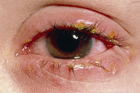Hình ảnh triệu chứng bệnh lậu ở mắt