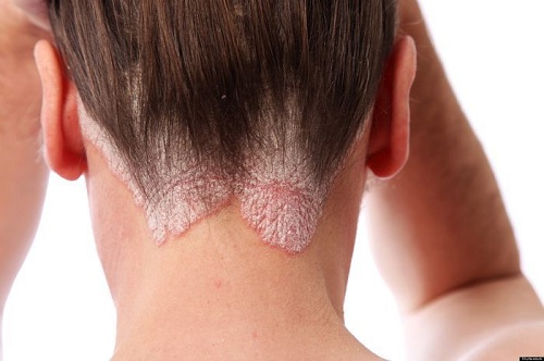 Bệnh vảy nến da đầu có lây không, phương pháp điều trị vảy nến da đầu